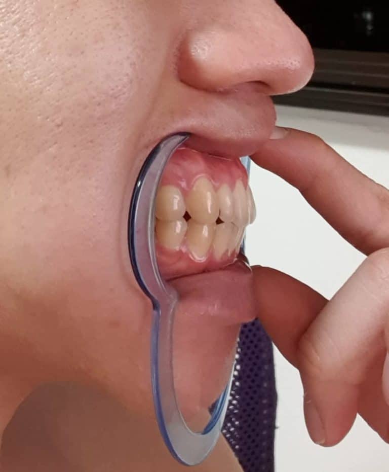 哨牙治療